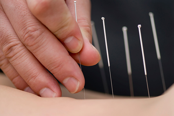 oa-Acupuncture-for-Osteoarthritis.jpg